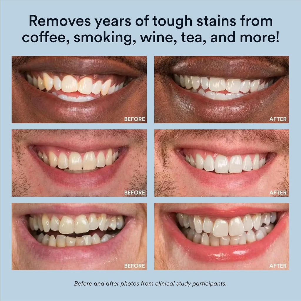 Professional LED Teeth Whitening Kit | Helps Brighten & Remove Surface Stains