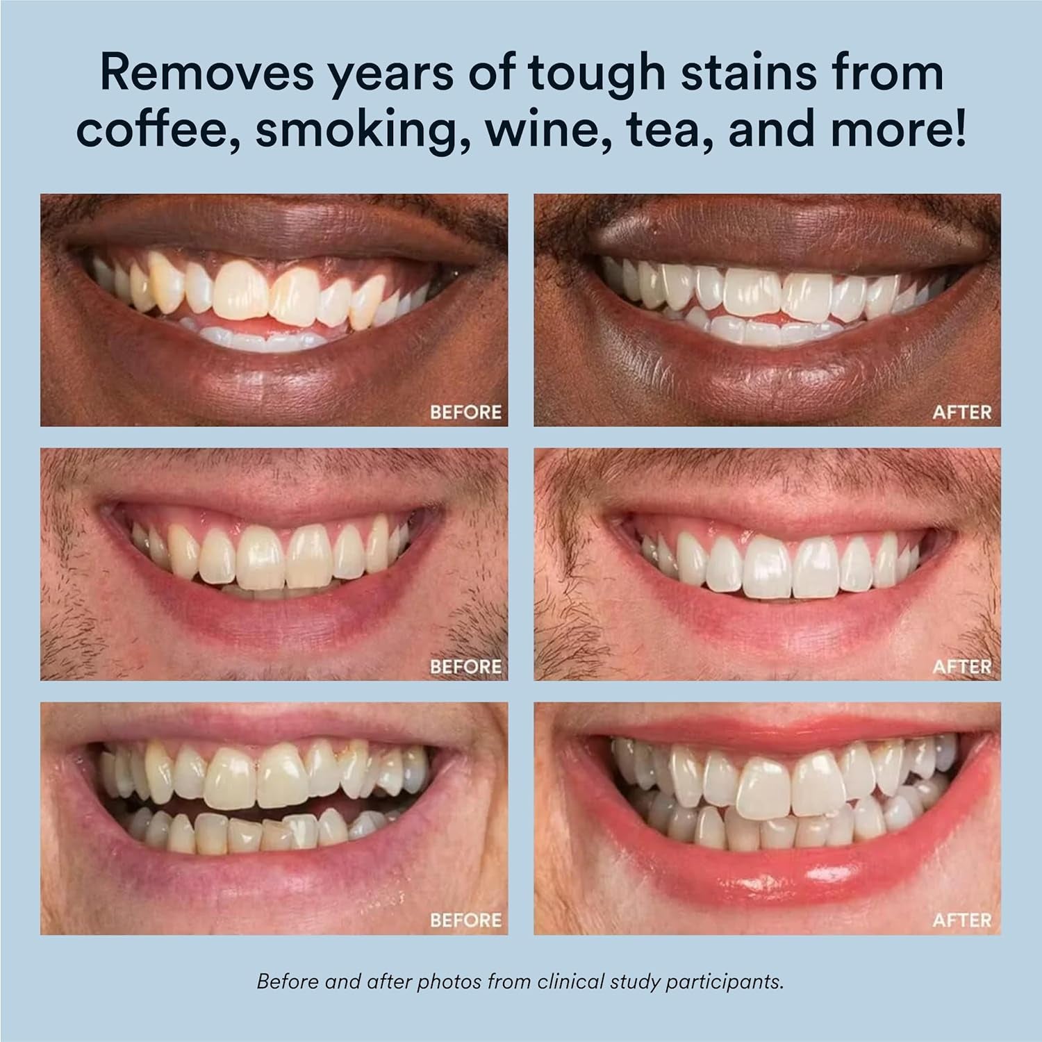 Professional LED Teeth Whitening Kit | Helps Brighten & Remove Surface Stains